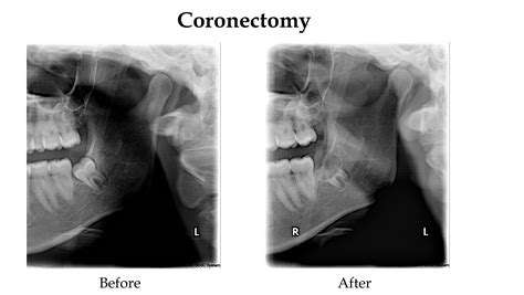Coronectomy Surgical Decoronation Of Impacted Teeth News Dentagama