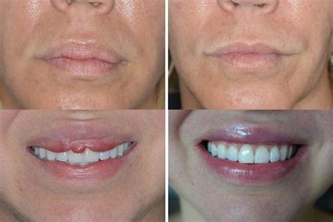 lip reduction surgery miami facial cosmetic surgery florida
