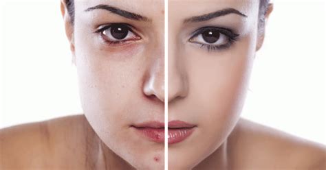 First, a little acne 101: 14 Natural Ways To Get Rid of Acne Forever! - Indiatimes.com