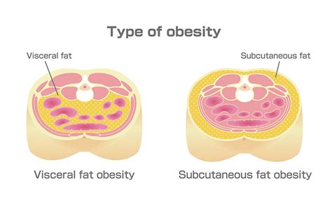 Type Of Obesity Illustration Abdominal Sectional View Visceral Fat Subcutaneous Fat