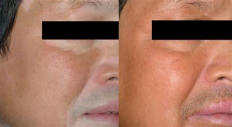 Uvb Phototherapy For Vtiligo Uvb Lamp For Vitiligo Before And After