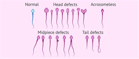 Analysis Of Sperm Morphology