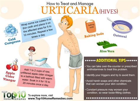 How To Treat And Manage Urticaria Top 10 Home Remedies Urticaria