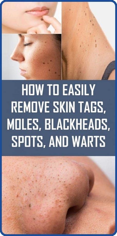 7 easy ways to remove skin tags without visiting a doctor kikotest medium