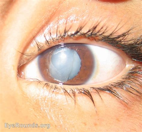 Traumatic Cataract Ruptured Capsule Online Ophthalmic