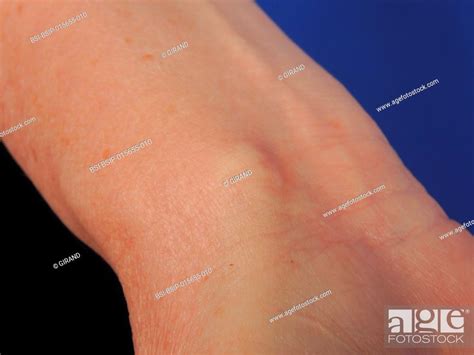 Synovial Cyst Of The Wrist Stock Photo Picture And Rights Managed Image Pic BSI BSIP