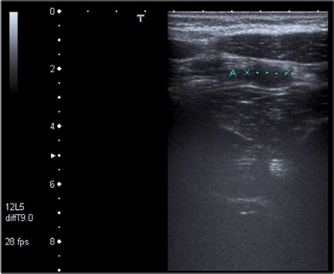 Longitudinal Ultrasound Scan Showing Tubular Blind Ended Structure