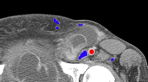 Please show me example sentences with groin. Inguinal Neuralgia | Colorado Pain - Denver, Golden