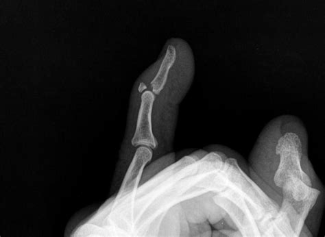 Mallet Finger Radiology Case Hand Therapy