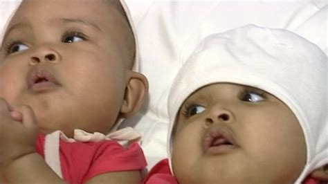 Doctors Successfully Separate Twins Joined At The Head Bbc News