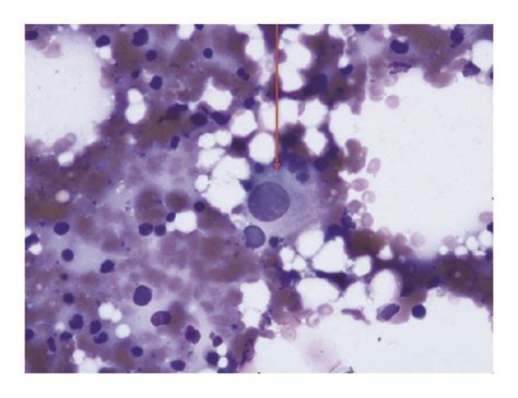 Bone Marrow Aspirate Smear Dysplastic Megakaryocyte 100x