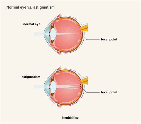 Astigmatism Causes Types Symptoms And Treatment