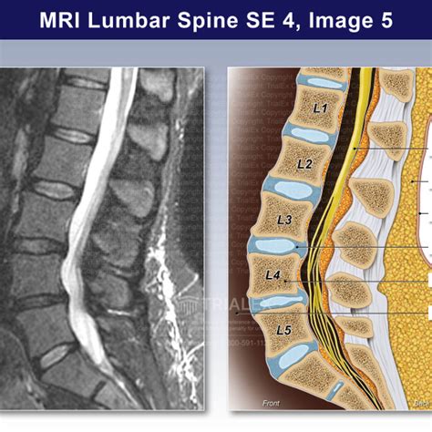 Mri Lumbar Spine Trialexhibits Inc