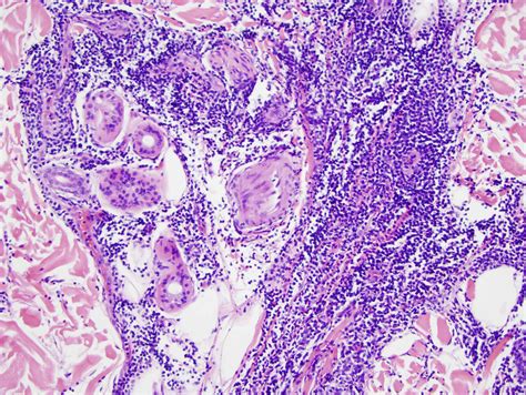 Non Scarring Discoid Lupus With Overlapping Jessners Lymphocytic