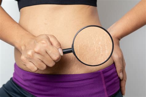 Get Rid Of Unwanted Stretch Marks Effectively With A Virtuerf Treatment