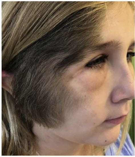 Hypertrichosis Of The Right Side Of The Face And Periorbital Swelling