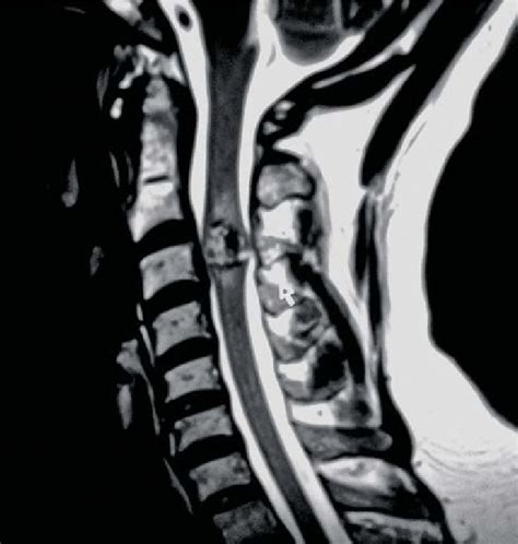 Sagittal T2 Weighted Imaging Of The Cervical Spine Showing A Spinal