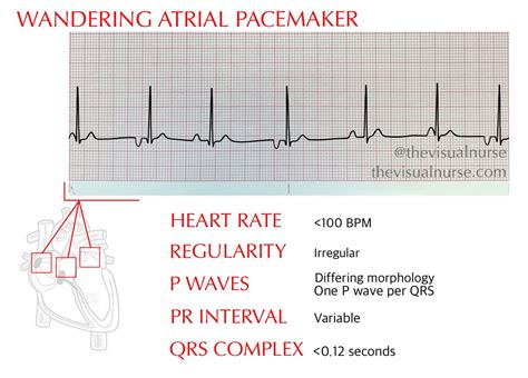 Wap Vs Mat On Ecg Whats The Difference — The Visual Nurse