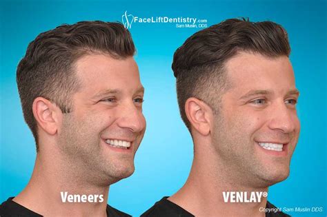 How to fix an overbite with braces. Overbite Fix, No Braces, No Aligners, No Surgery, 8-Days