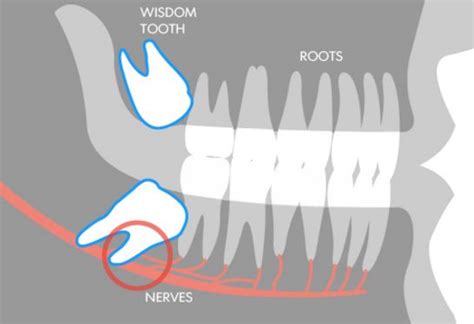 Wisdom Teeth Should They Stay Or Go