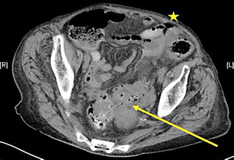 Figure 1 From Perforated Sigmoid Diverticulitis In The Presence Of