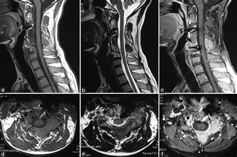 Solid Variant Of Aneurysmal Bone Cyst Presenting As A Giant Cervical