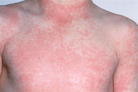 Identifying Skin Rashes Children
