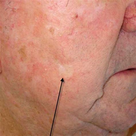 Skin Cancer Melanoma Signs And Symptoms 2023