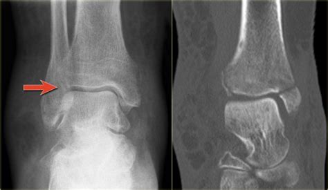 The Radiology Assistant Special Ankle Fractures