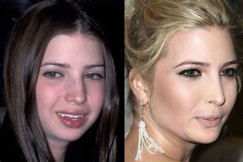 20 Celebrity Before And After Plastic Surgery Disasters Page 11