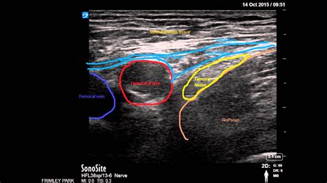Lateral Femoral Cutaneous Nerve Block Ultrasound Porn Sex Picture