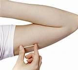 Photos of Rod Implant Contraceptive Side Effects