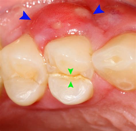 Complications Of Tooth Abscess General Center