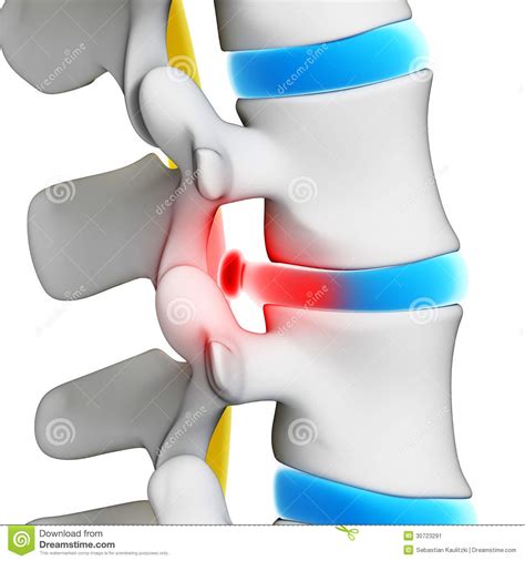 Herniated disk stock illustration. Illustration of thoracic - 30723291