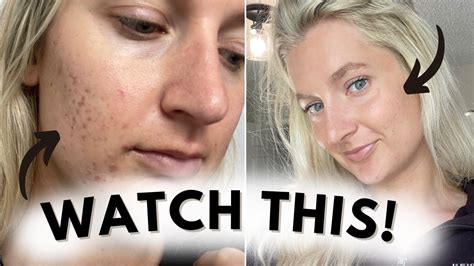 Watch This Before Using Tretinoin From Cystic Hormonal Acne To Clear