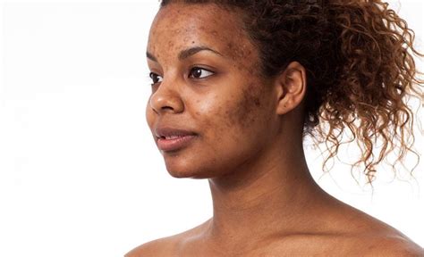 Deep Acne Scars Prevention Tips And Treatment Guide Alinea Med Spa