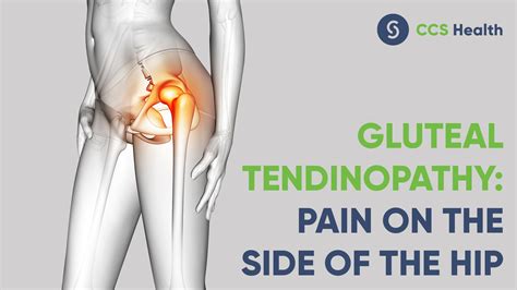 Ancora Evidenziare Ammissione Gluteal Tendinitis Partorire Marchio