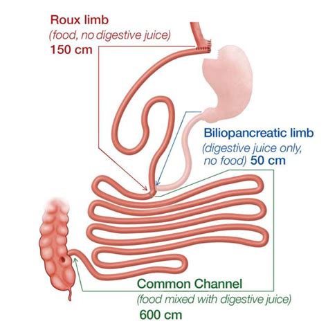 Gastric Bypass Revision Bariatric Surgery Ucla Health