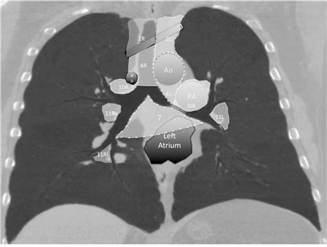 Diagnosing And Staging Lung Cancer Involving The Mediastinum Chest