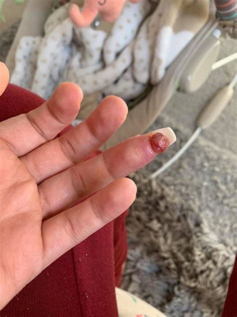 Woman Almost Needed Part Of Her Finger Amputated After Acrylic Nails