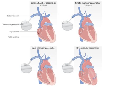 Implantable Cardioverter Defibrillator Vs Pacemaker