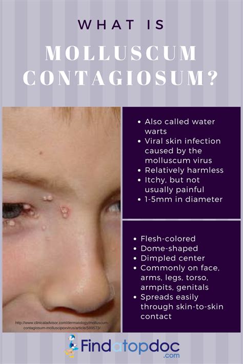 What Is Molluscum Contagiosum Treatment And Home Remedies