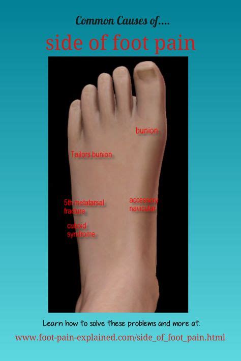 Top Side Foot Pain Chart