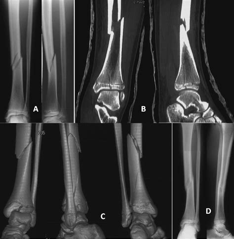 Concomitant Tibia Shaft And Distal Triplane Fractures Sferopoulos