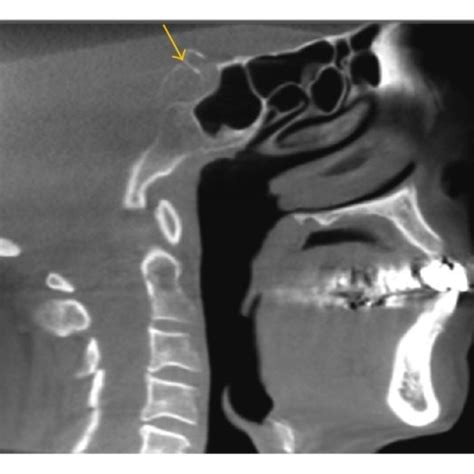 A Coronal View Shows Tonsilloliths Within The Tonsils Download