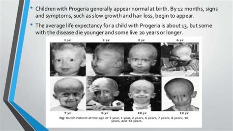 Fajarv Progeria Disorder Life Expectancy