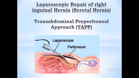 Transabdominal Preperitoneal Approach Tapp Youtube