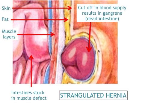 Ventral Hernia Clinic Surgeon Incisional Hernia Surgery Clinic Umbilical And Paraumbilical