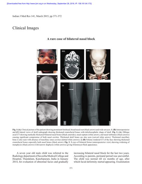 Pdf A Rare Case Of Bilateral Nasal Block