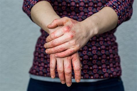 Eczema Atopic Dermatitis Symptoms Causes Treatment And Photos